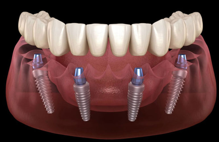 ALL ON 4 - Implante dentare