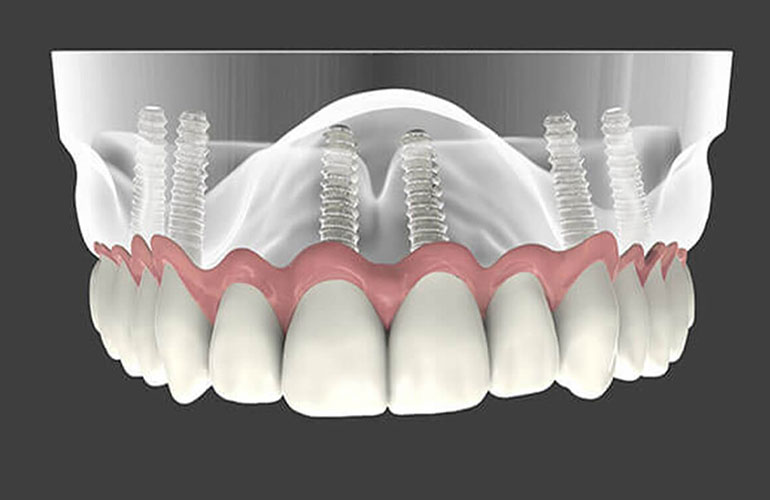 ALL ON 6 - Implante dentare