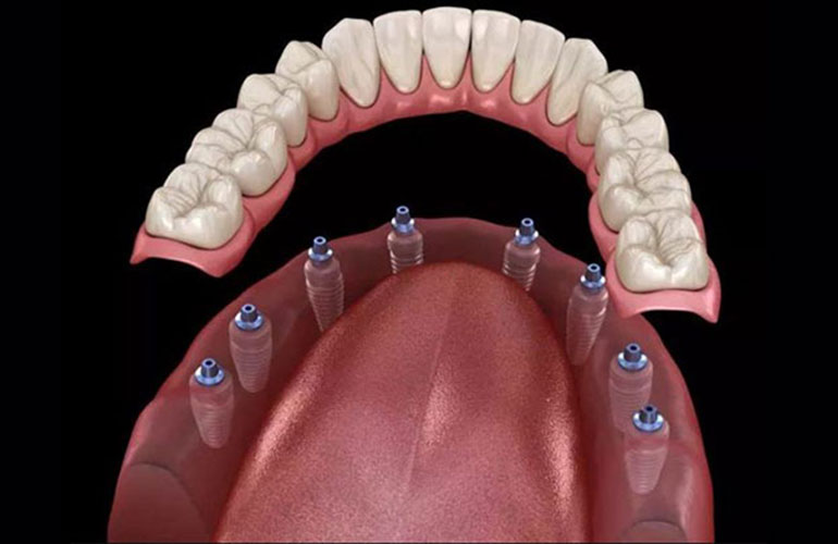 ALL ON 8 - Implante dentare